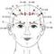 דיקור קרקפת בשיטת YNSA - Yamamoto New Scalp Acupuncture
