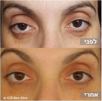 דיקור קוסמטי - הרמת עפעפיים וטשטוש עיגולים שחורים