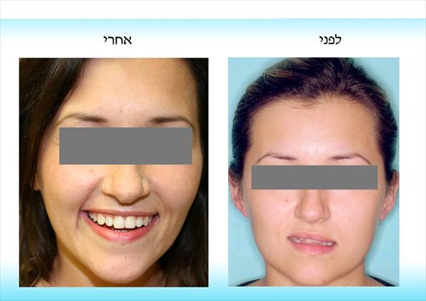 יישור שיניים לגברת א'