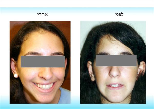 יישור שיניים לגב' ג'
