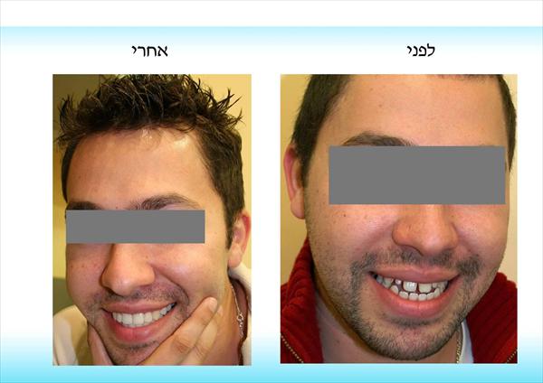 יישור שיניים לאדון ד'