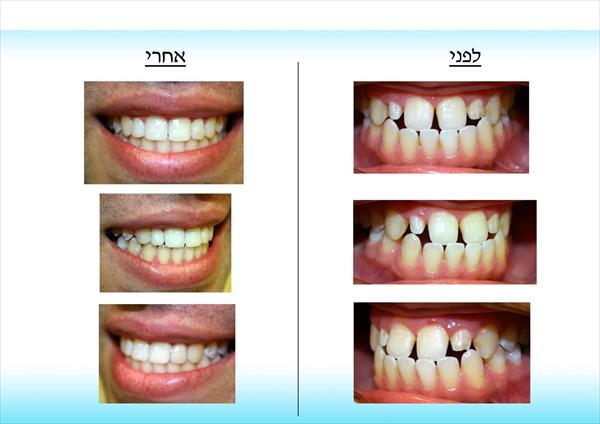 יישור שיניים לאדון ד'