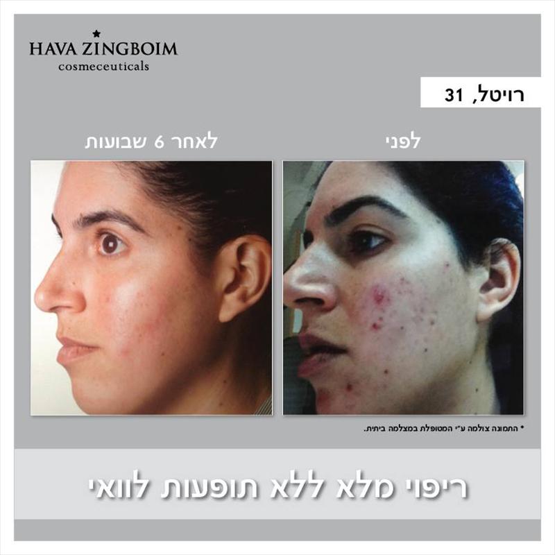 ריפוי אקנה