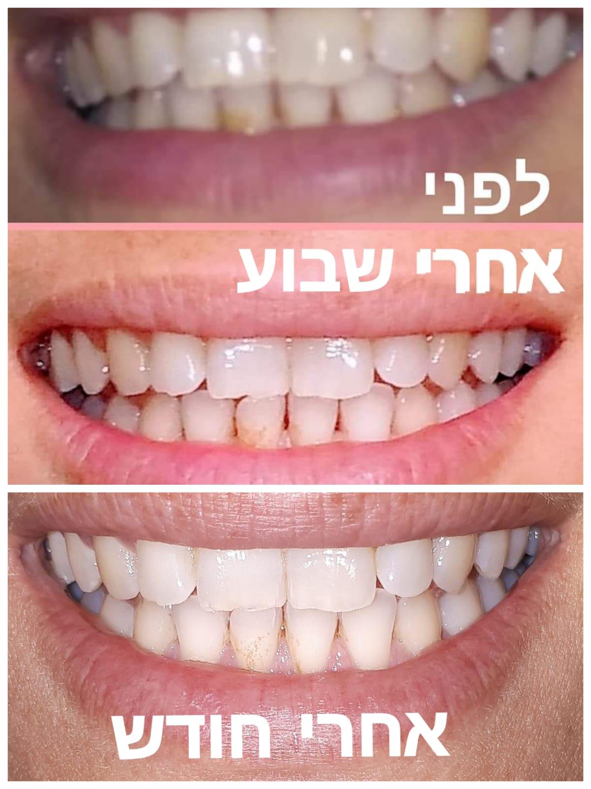 לפני ואחרי שימוש במשחה המלבינה