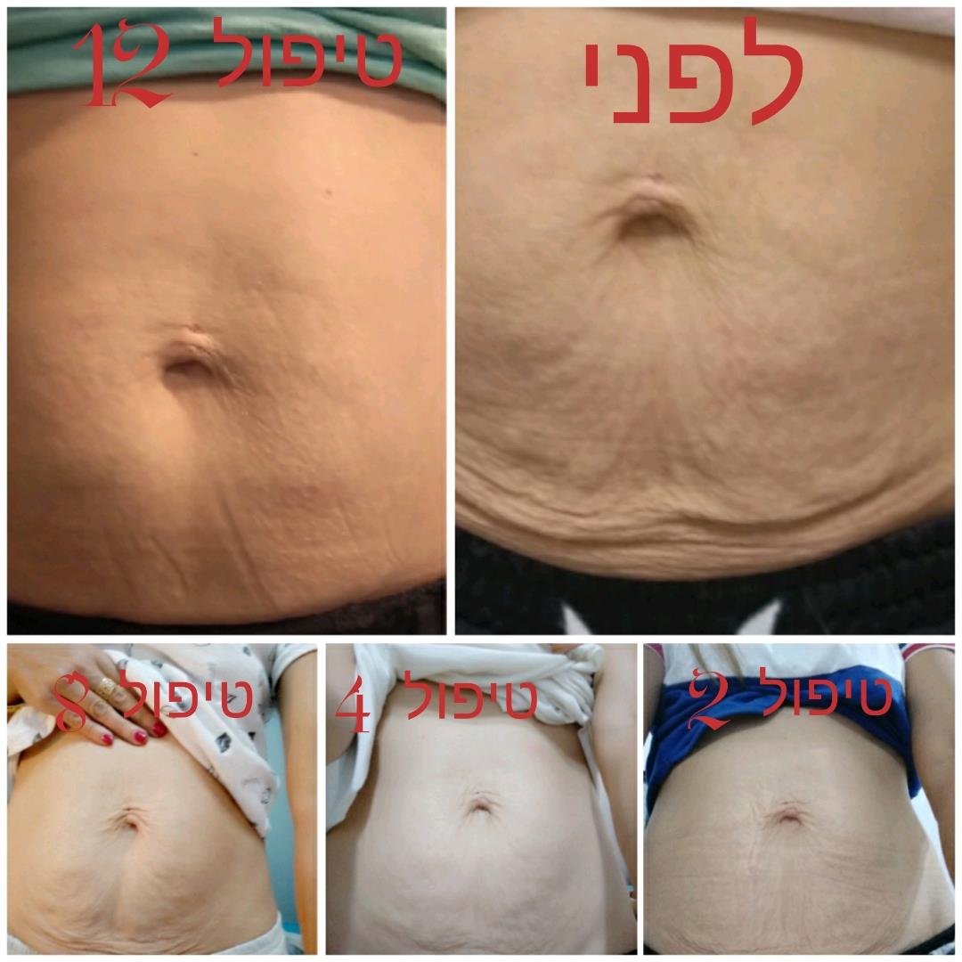 עור רפוי אחרי לידה - טיפול ומיצוק