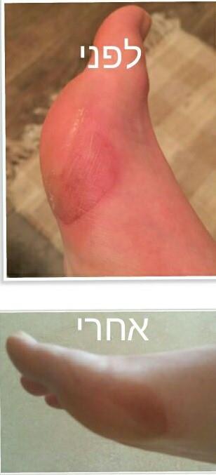 טיפול ביבלות