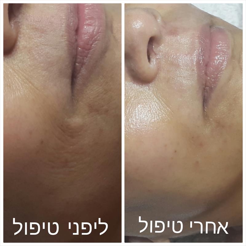 אנטיאג'נג