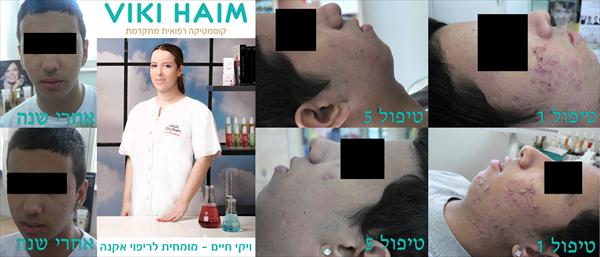 ויקי חיים מומחית לאקנה נוער