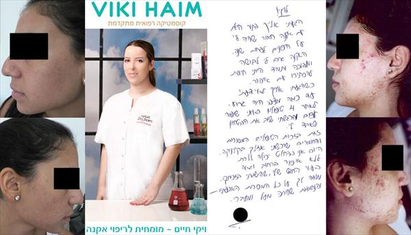 ויקי חיים מומחית לריפוי אקנה לחיילים