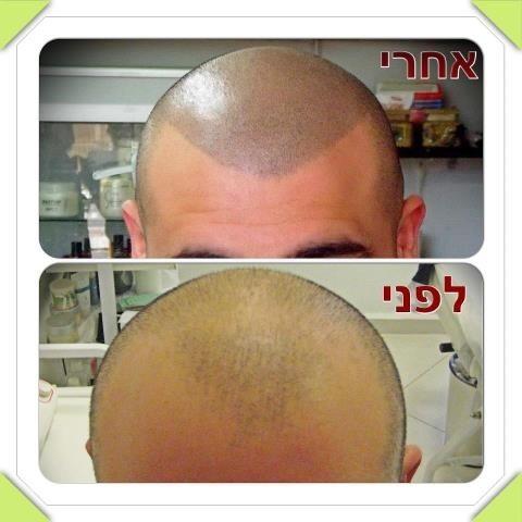 הדמיית שיער- מילוי קרקפת