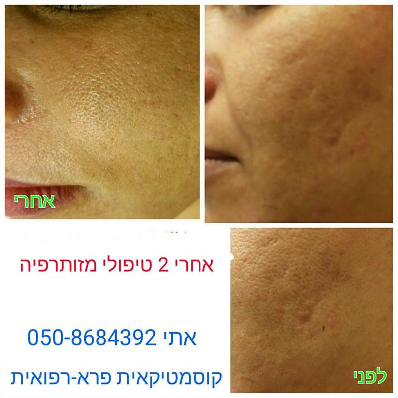לקוחה מרוצה מטיפול במכשיר מזותרפיה