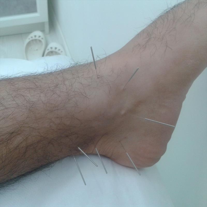 דיקור גוף לכאבים ומחלות פנימיות.