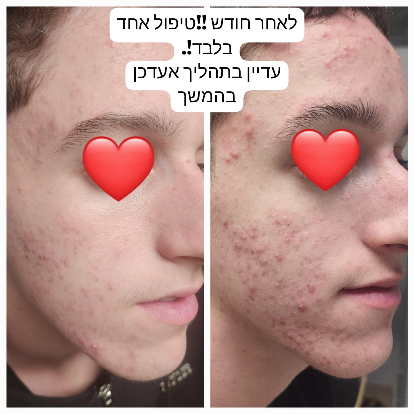 טיפול באקנה ופוסט אקנה