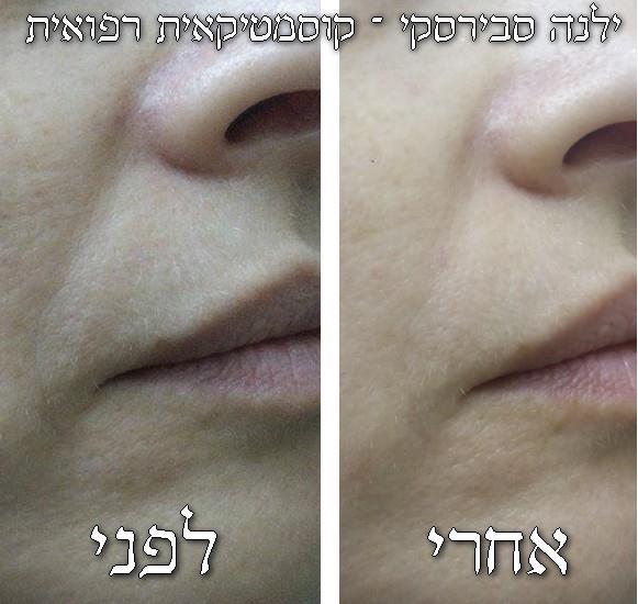 טיפול אנטי אייג'ינג