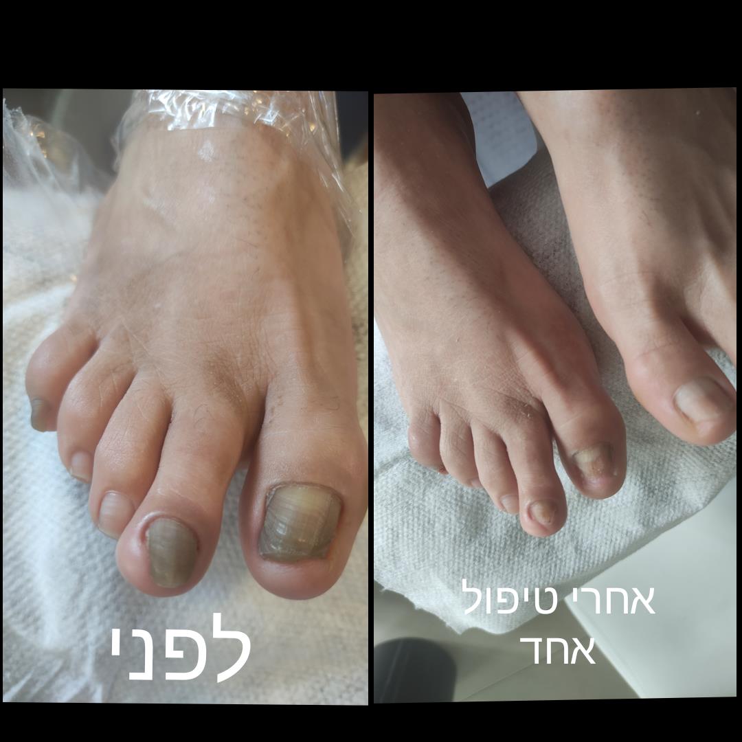 פדיקור רפואי