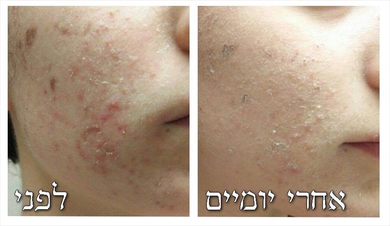 טיפול אקנה