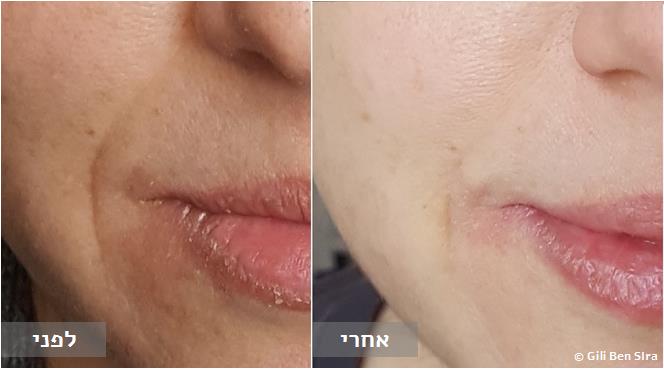 דיקור קוסמטי - טשטוש קמטים