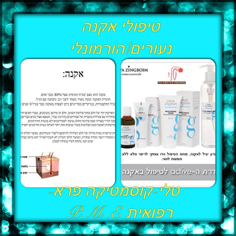 אקנה נעורים- יש פתרונות איך לעבור את זה בשלום...