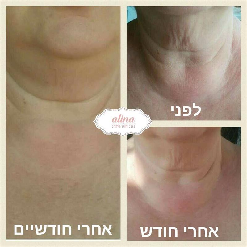 ליפטינג לצוואר ללא שום התערבות כירורגית