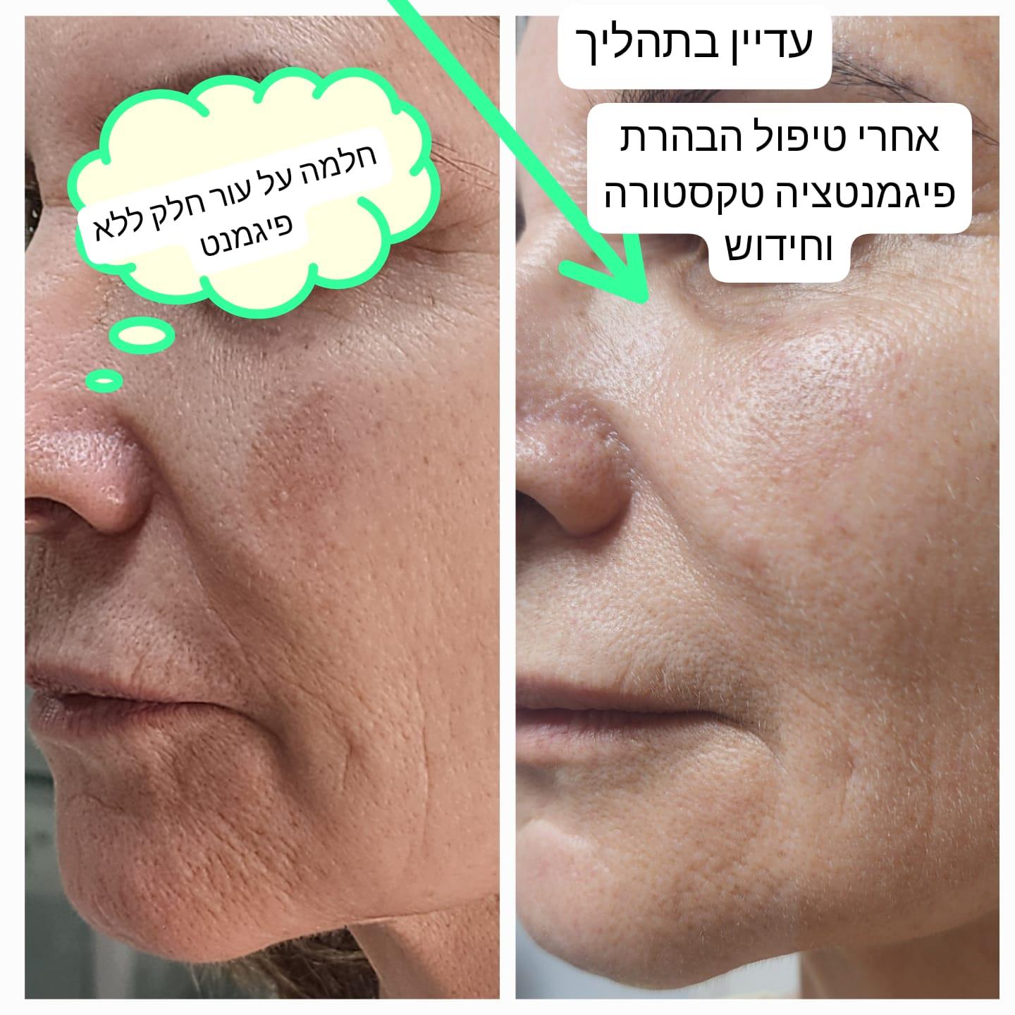 מיניליפט פנים
