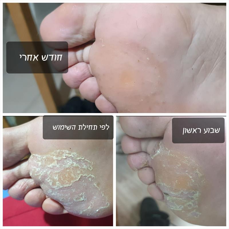 אקזמה קשה שטופלה