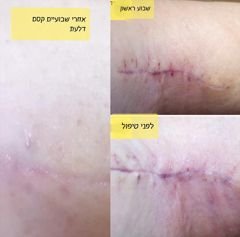 צלקת לאחר ניתוח