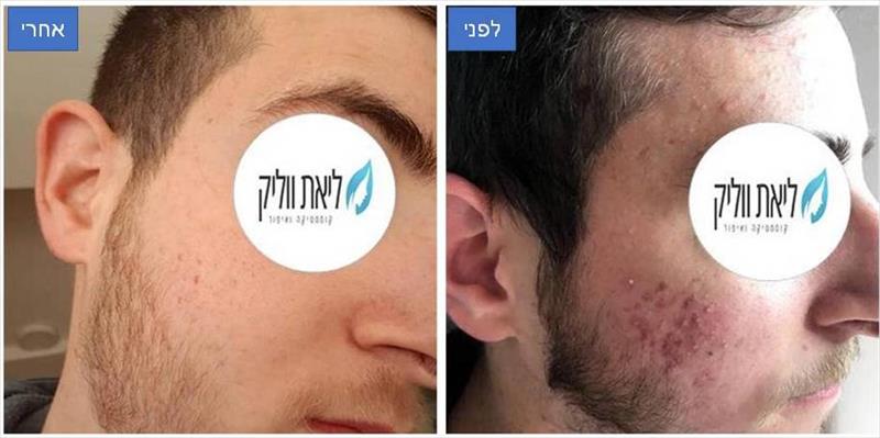 טיפול באקנה