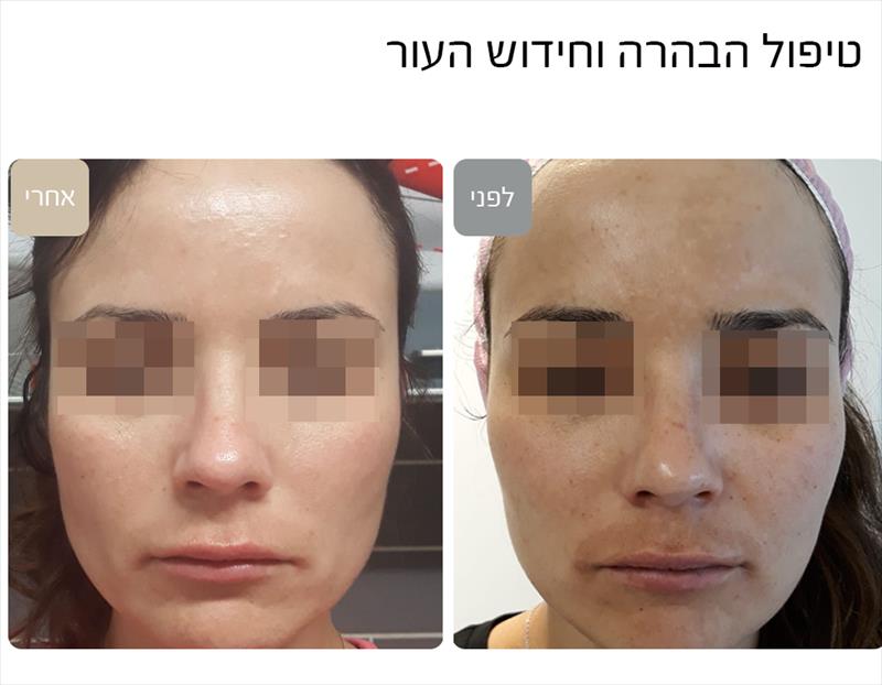 טיפולי הבהרה וחידוש העור - לפני ואחרי
