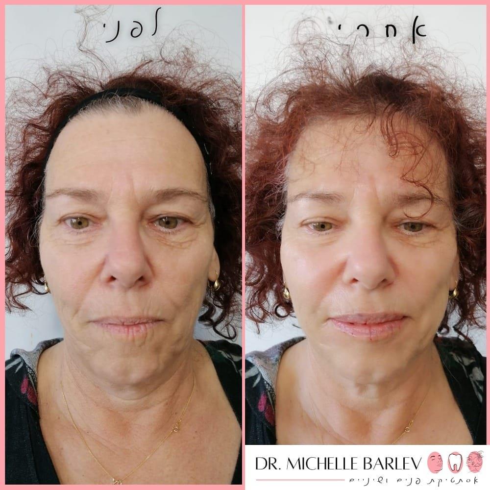 Full face