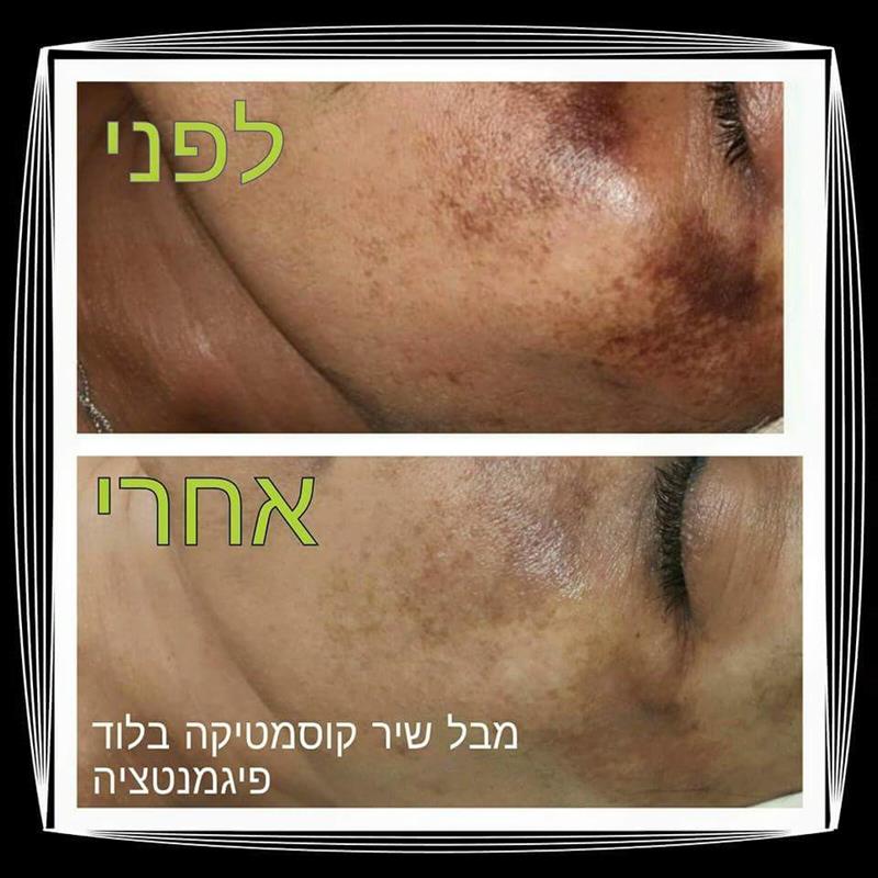 פגמנטציה