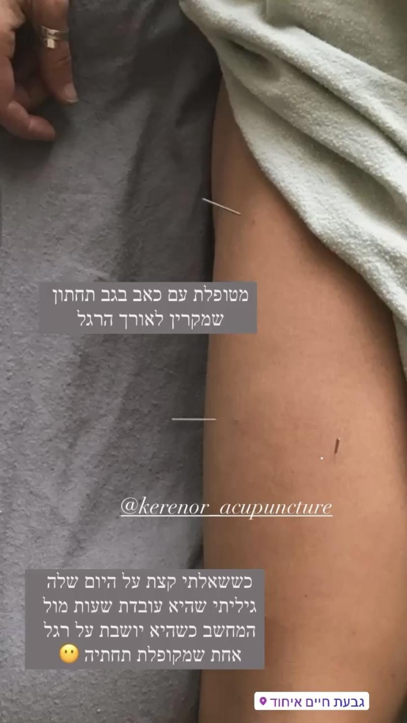 דיקור יפני לכאבי כב
