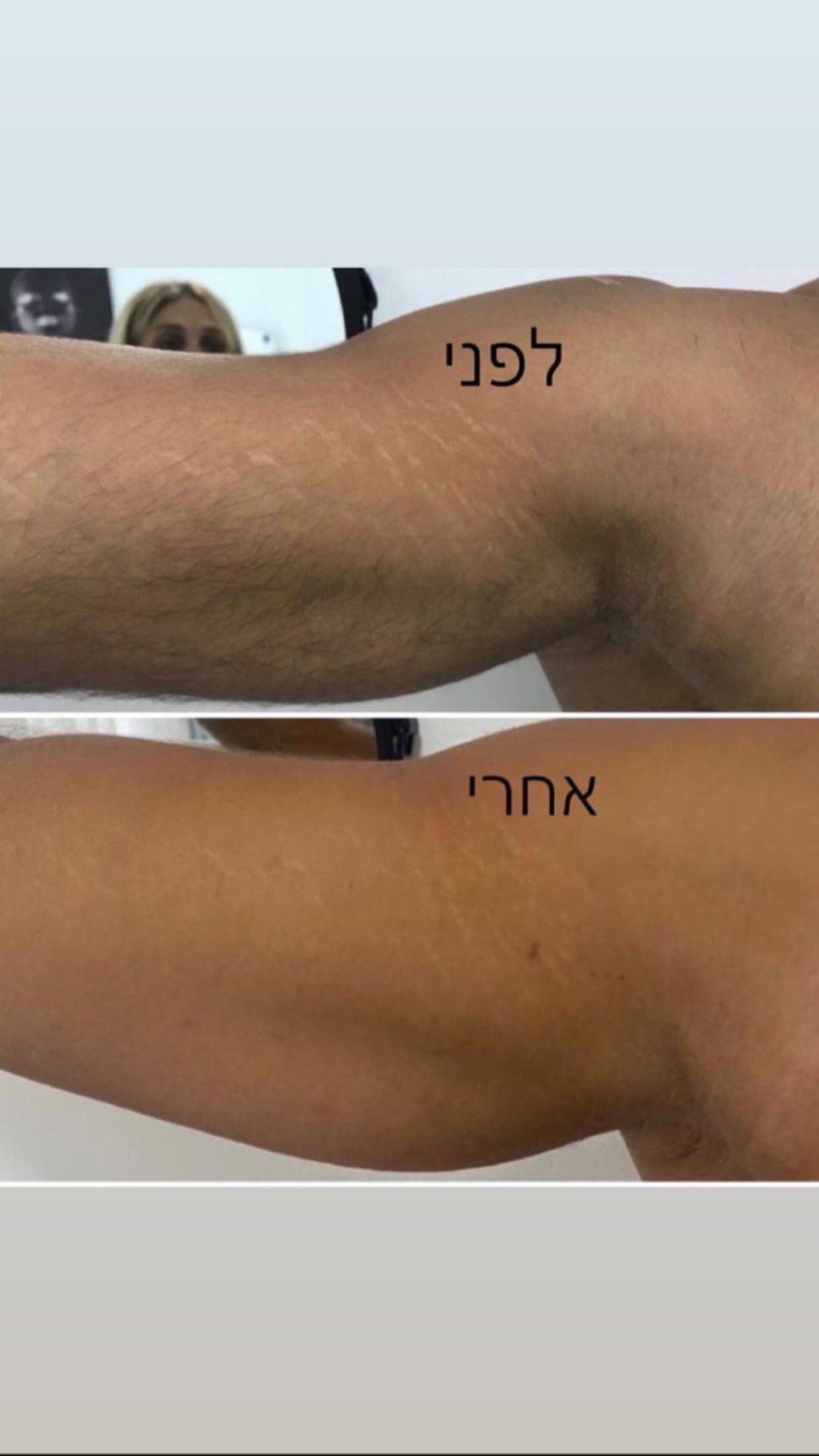 לפני ואחרי/גברים