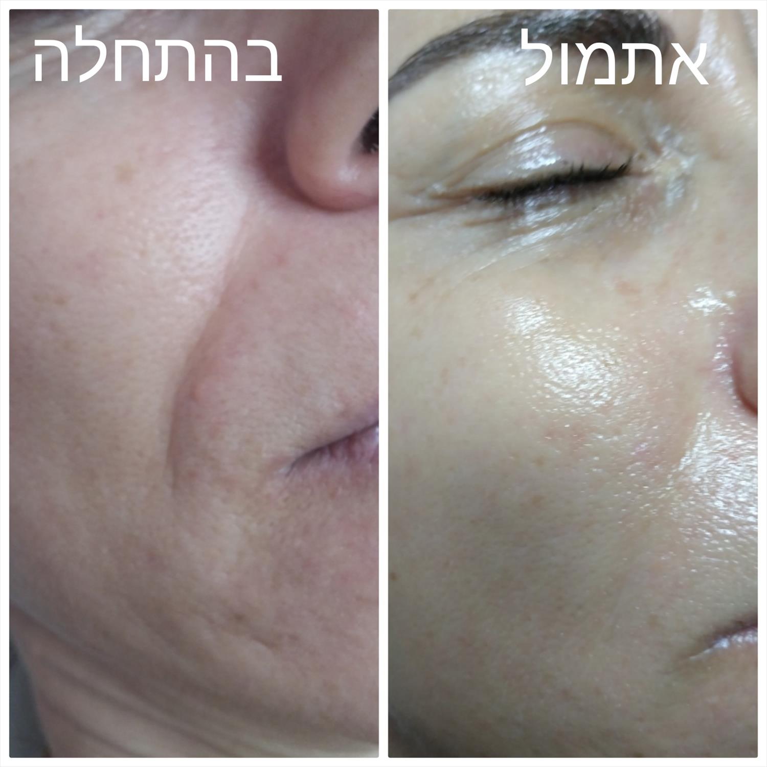 טיפול פנים קלאסי כולל ניקוי עמוק