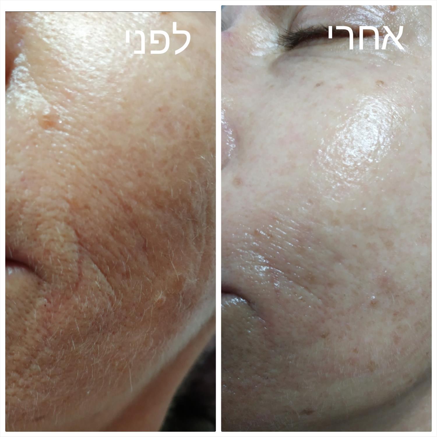 טיפולי מזוטרפיה הטרנד לאנטי-אייג'ינג