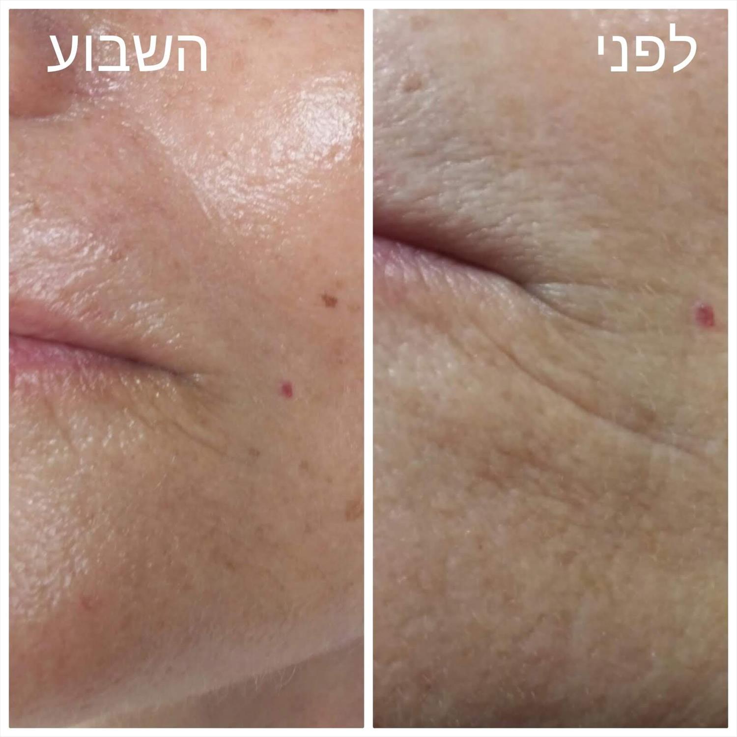 טיפול אנטי אייג'ינג