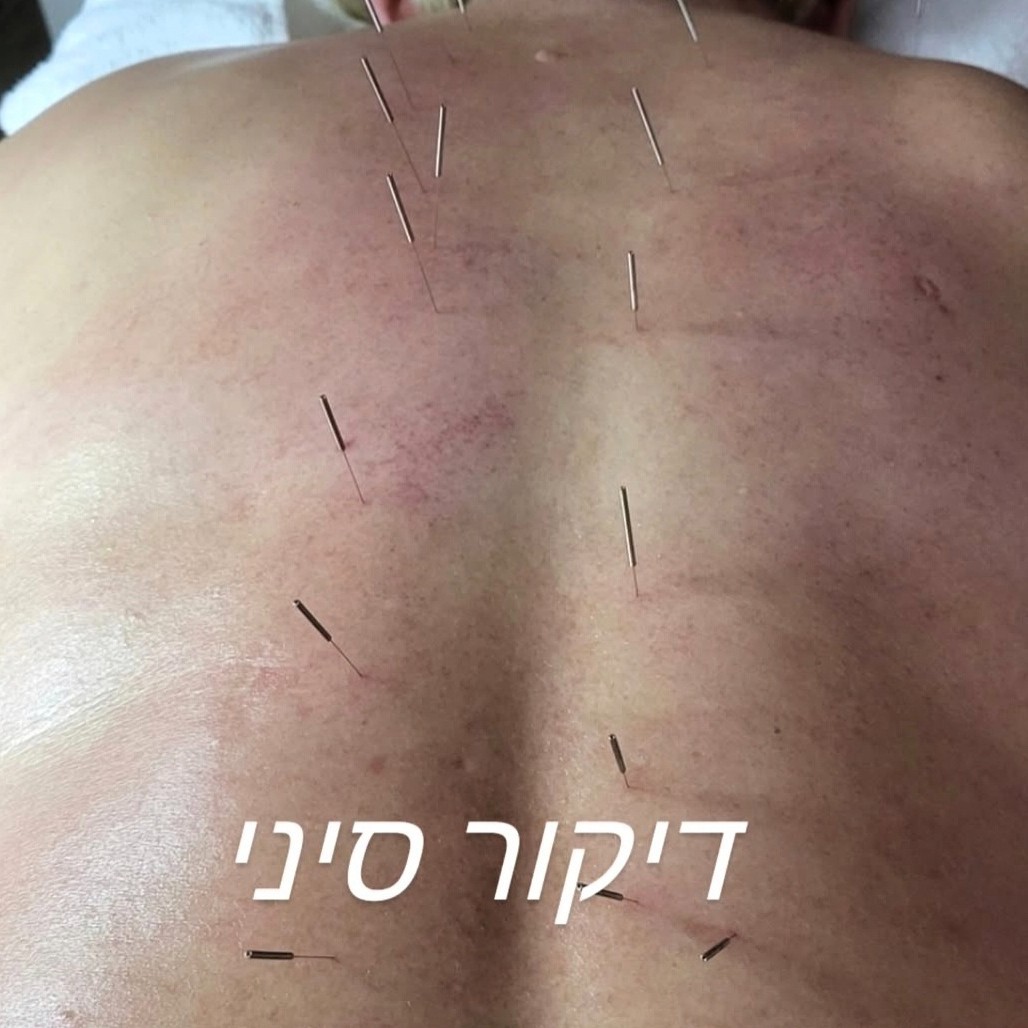 דיקור