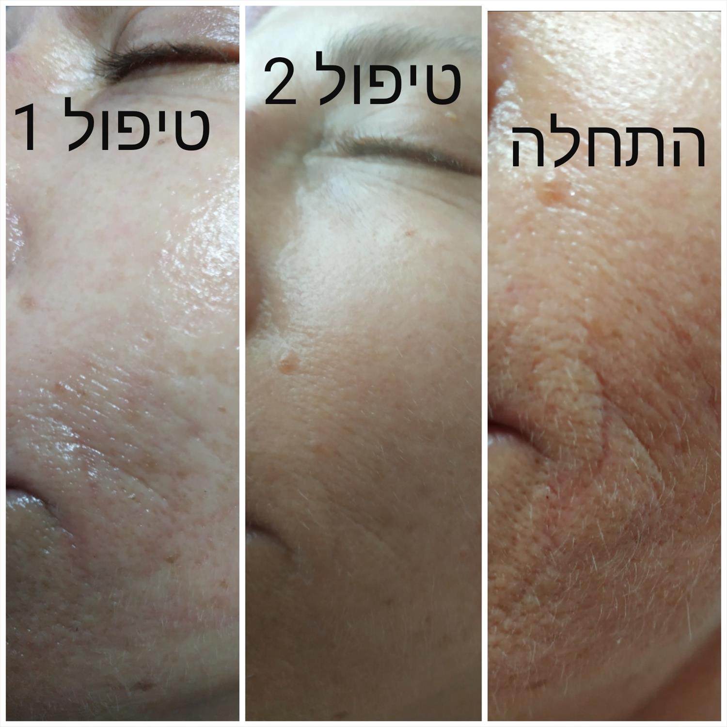 טיפולי אנטי אייג'ינג עם טכנולוגיות מתקדמות