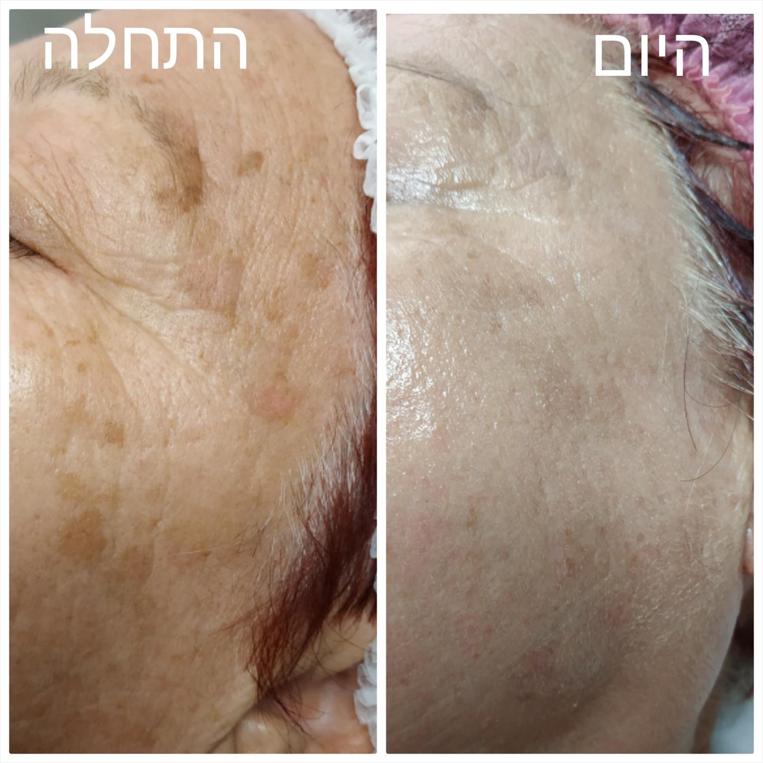 הבהרת כתמי עור