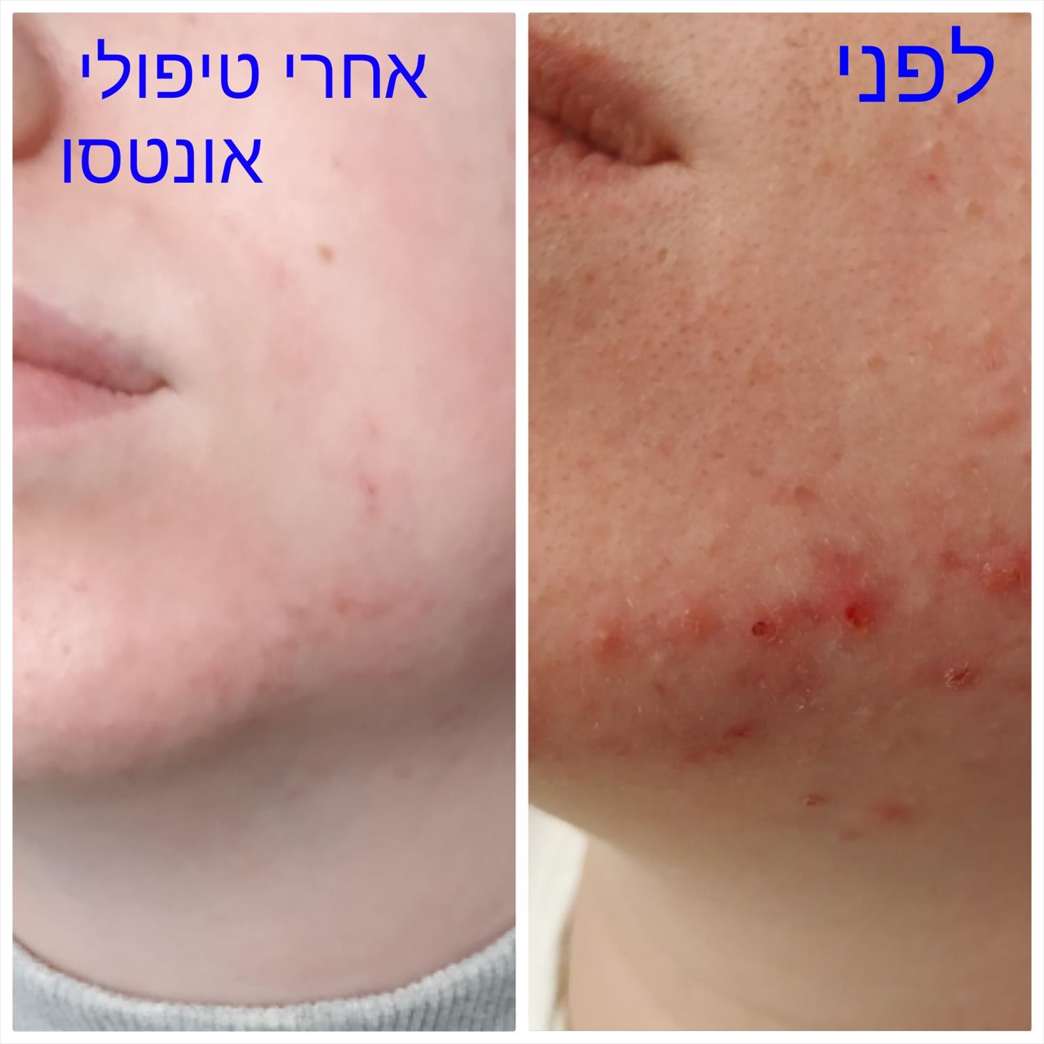 טיפול לאקנה קשה עם טכנולוגויות