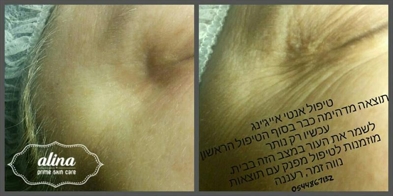 טיפול אנטי אייג'ינג לעיניים