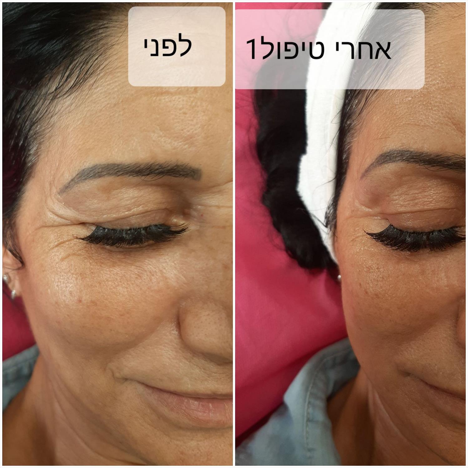 טיפולי אנטיאייג'נג
