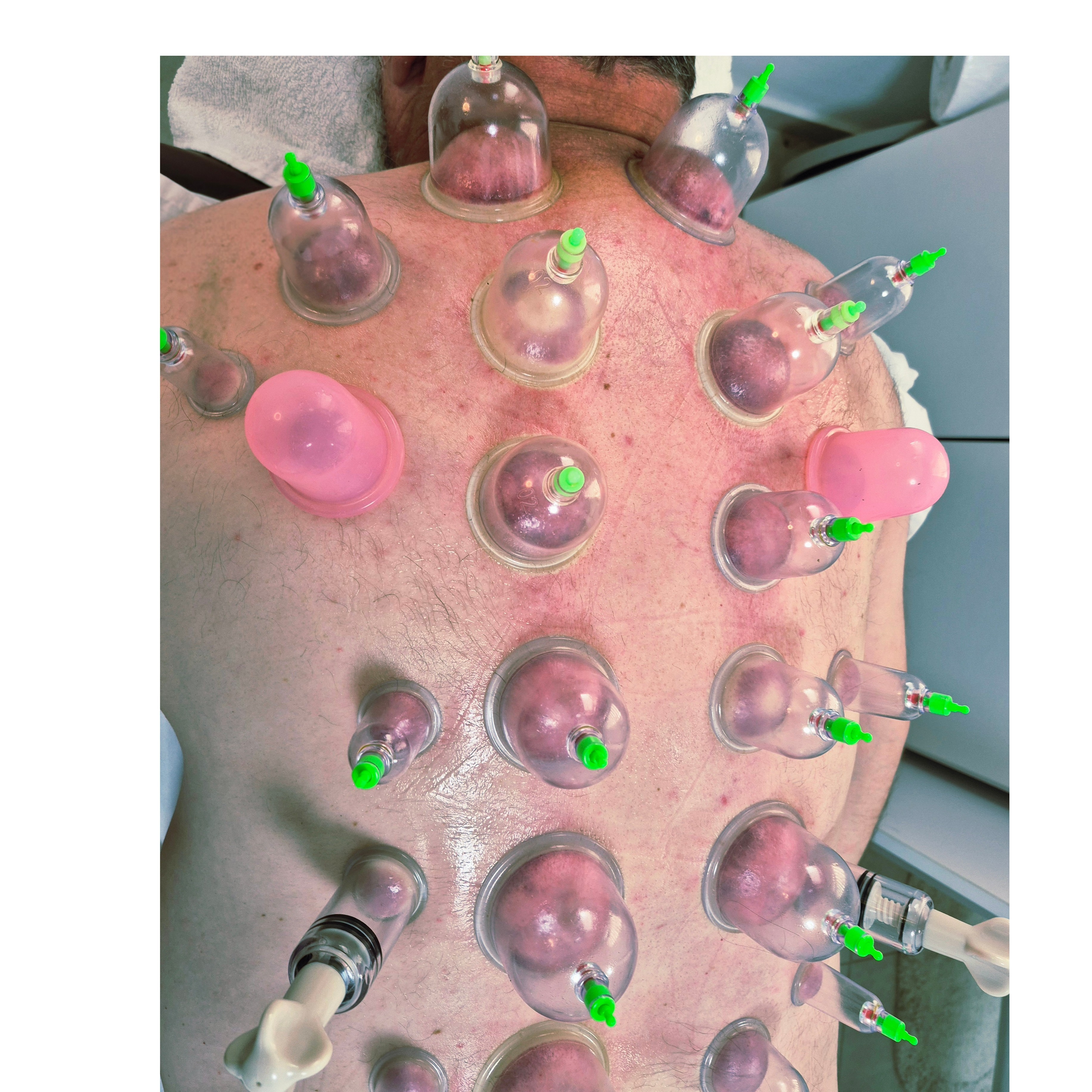 טיפול בכאבי גב, שכמות, סכיאטיקה